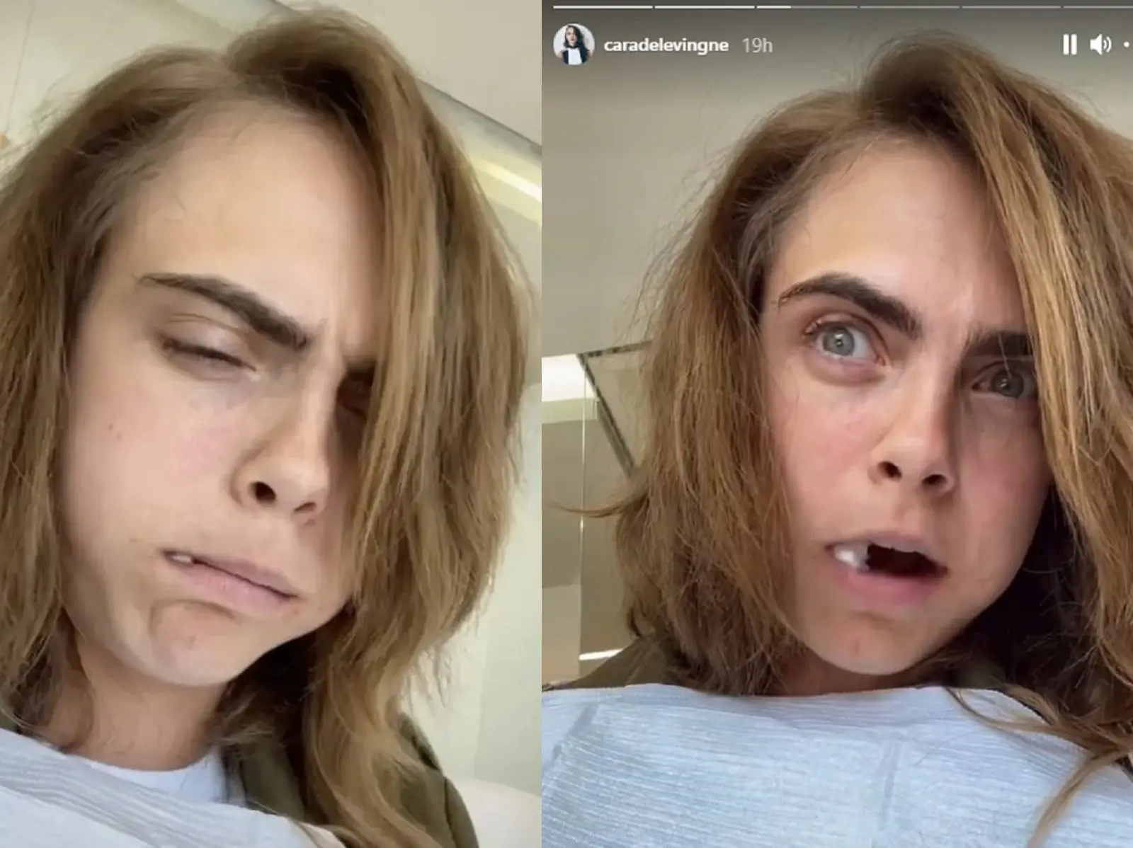 英國超模也懂！Cara Delevingne 拔智齒痛到懷疑人生：「我一直爆哭！」