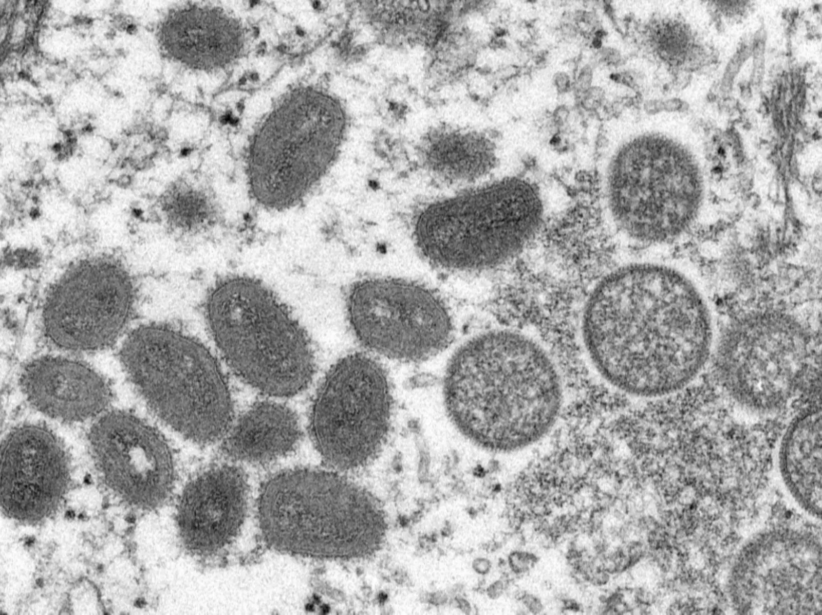 義大利男出國 5 天後卻同時感染「新冠、愛滋加猴痘病毒」，成為全球首例！