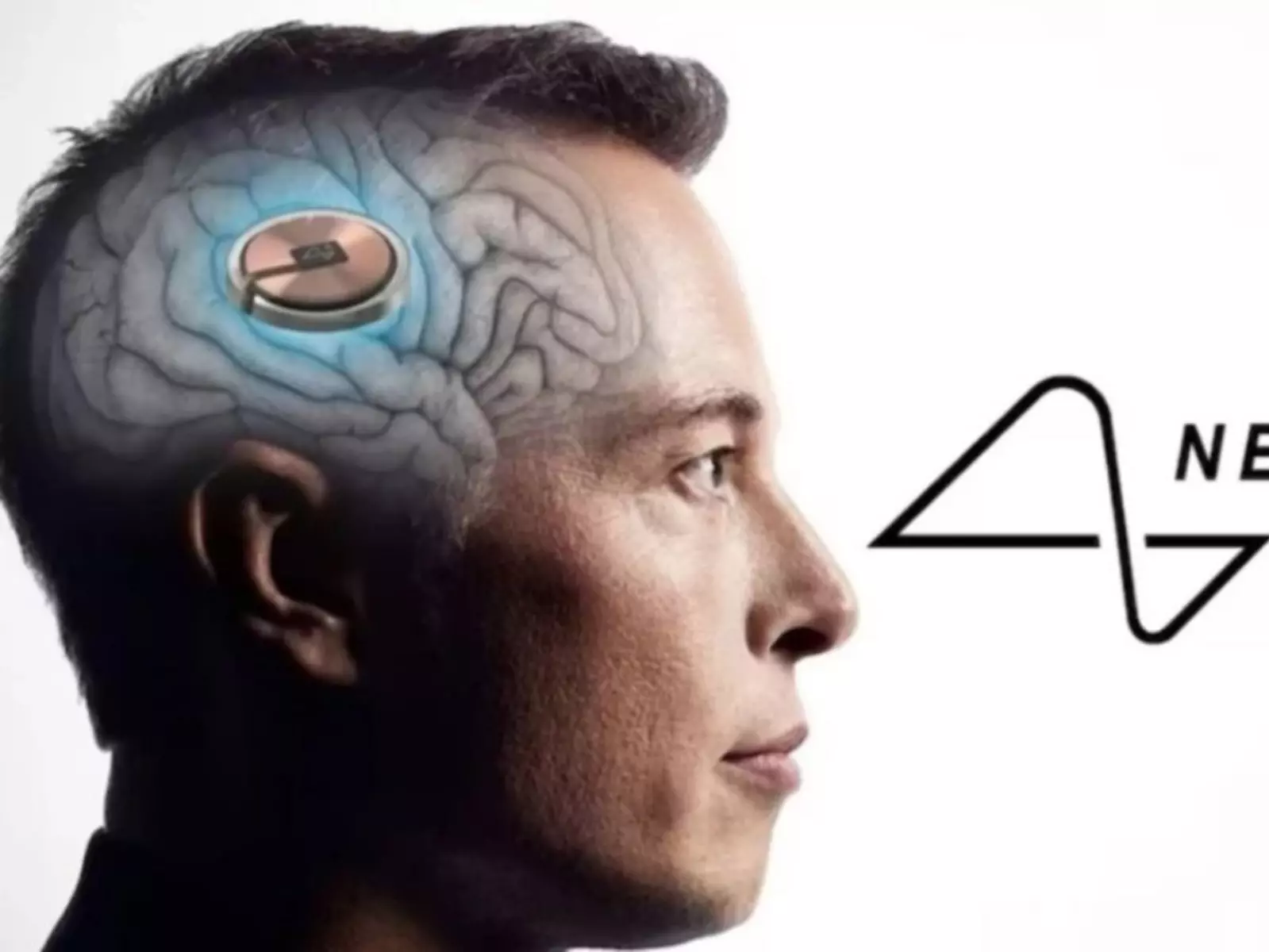 馬斯克大腦晶片公司 Neuralink 招募「植入手術試驗者」，超過千人瘋搶報名！