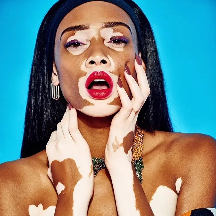 「缺陷是我前進的動力」！白斑超模 Winnie Harlow 