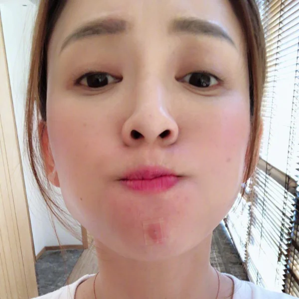 很多人都不正確使用暗瘡貼！暗瘡貼正確用法＋暗瘡位置毛病大公開