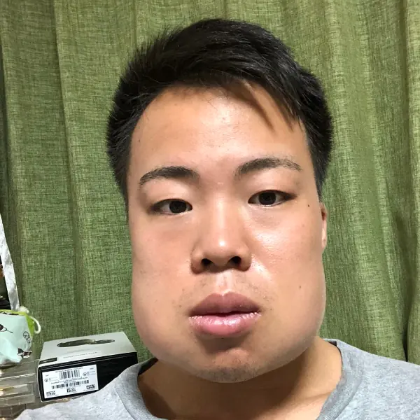 你也曾遭遇過嗎？日本男子一口氣拔 4 個智齒，臉頰慘變「戽斗」引眾人爆笑！